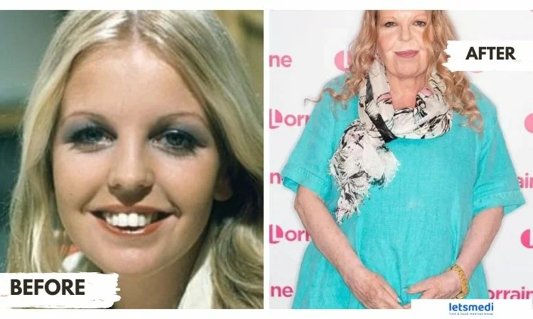 sally thomsett face surgery