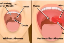 why does one side of my throat hurt when i swallow